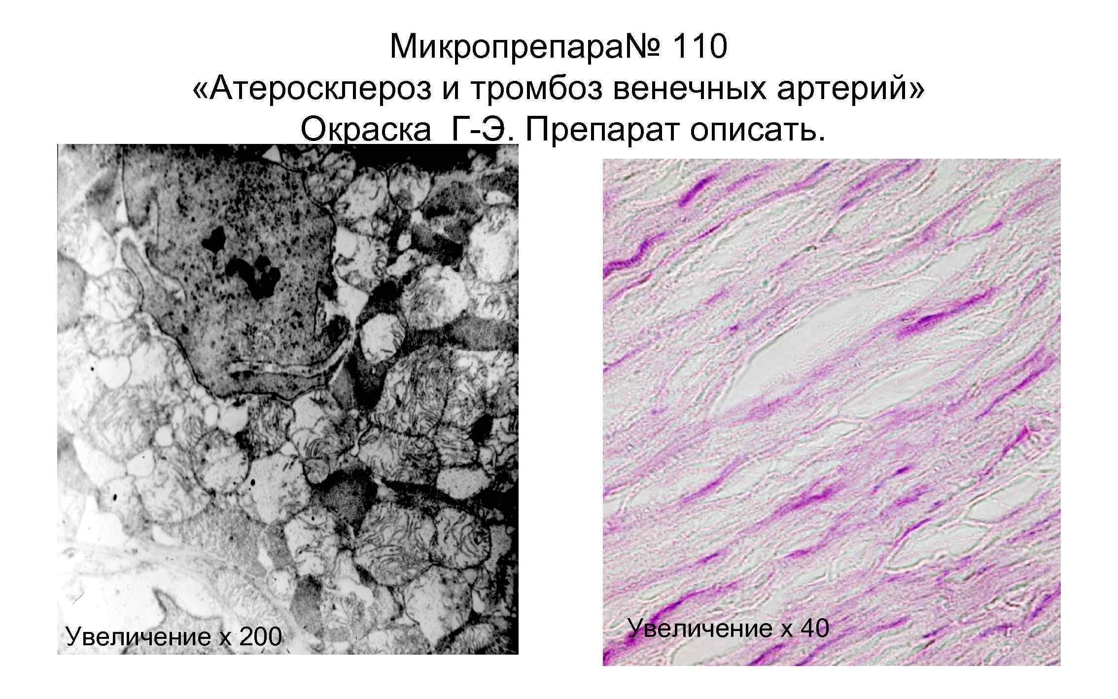 Тромб микропрепарат. Атеросклероз венечной артерии микропрепарат. Атеросклероз артерий гистология. Атеросклероз венечной артерии сердца микропрепарат. Стенозирующий атеросклероз микропрепарат.