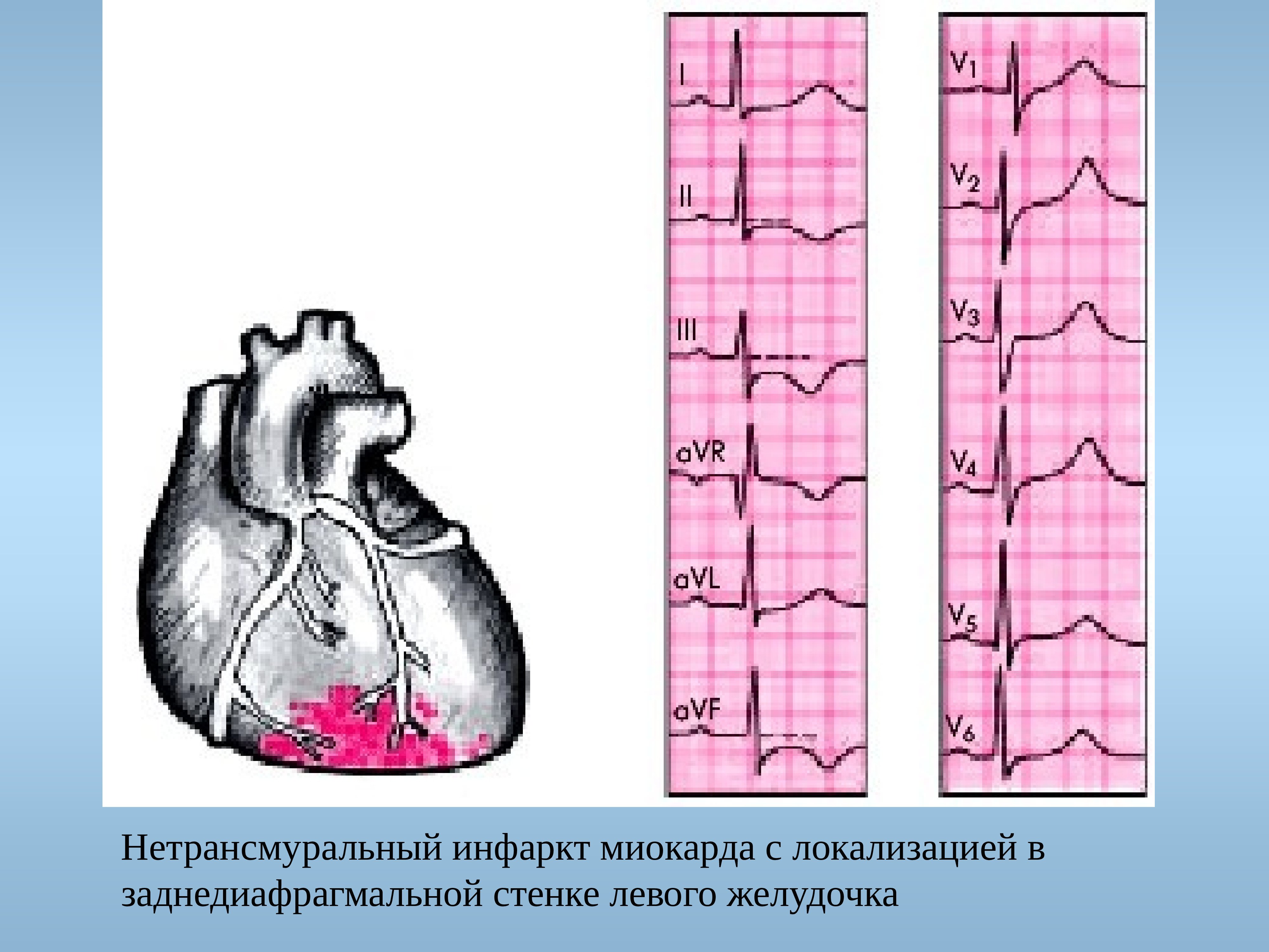 Неспецифические изменения нижней стенки. Острый Нижний (заднедиафрагмальный) инфаркт миокарда. Острый инфаркт миокарда задней стенки. Инфаркт миокарда нижней стенки лж. Острый задне-Нижний инфаркт миокарда.