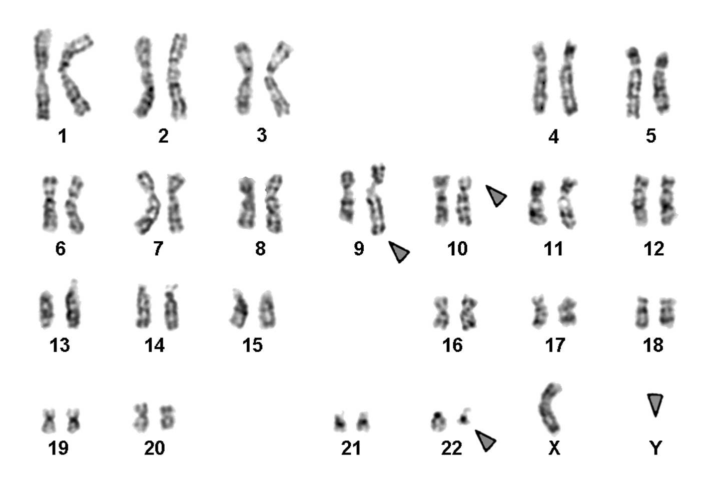 Спаривание хромосом. Кариотип обыкновенная бурозубка. Кариотип человека. Транслокация хромосом кариотип. Виды хромосом человека.