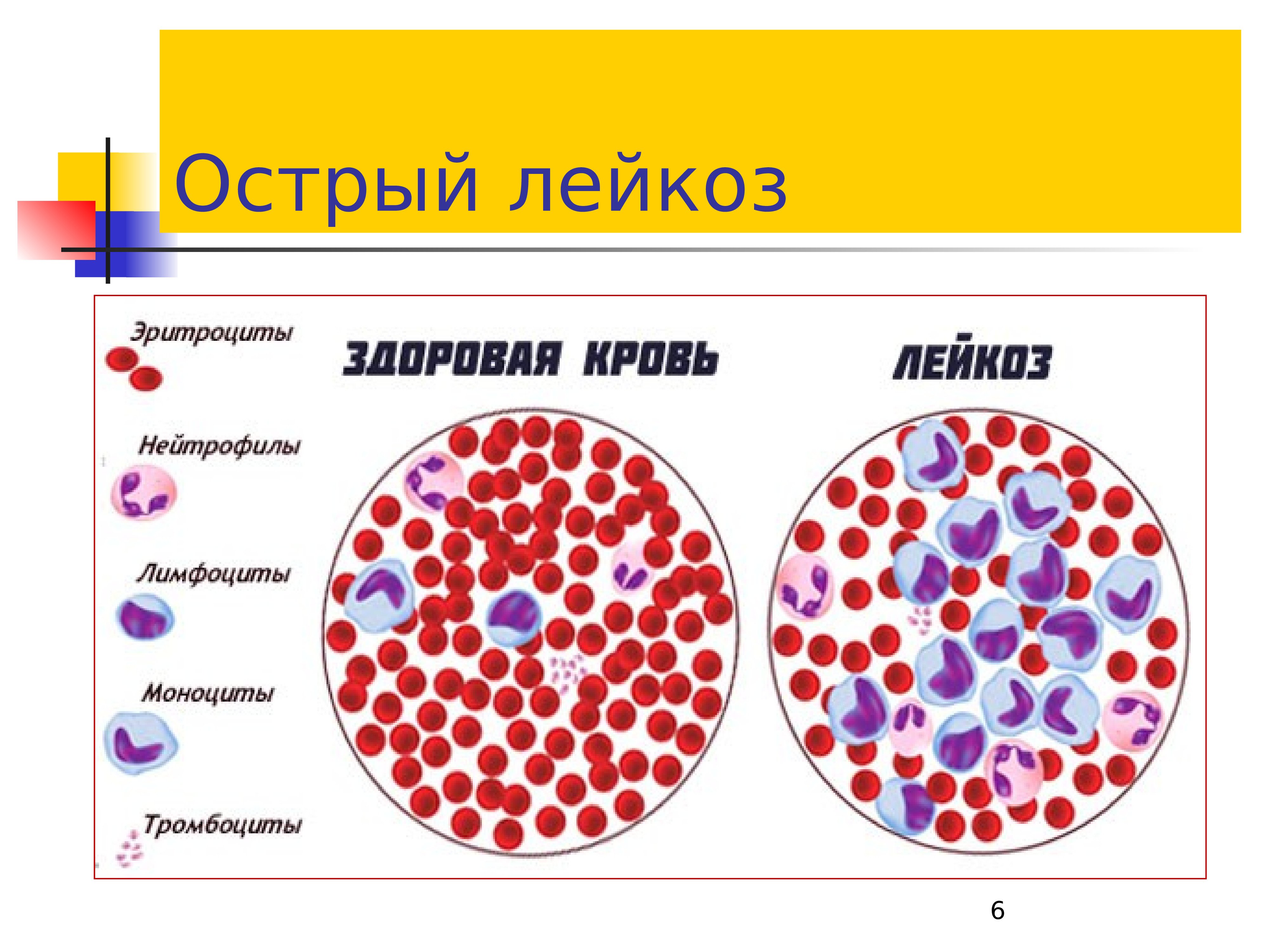 Заболевание острый лейкоз. Хронический миелолейкоз крови этиология. Миелобластный лейкоз картина крови. Острый миелобластный лейкоз кровь. Острый миелоидный лейкоз картина крови.