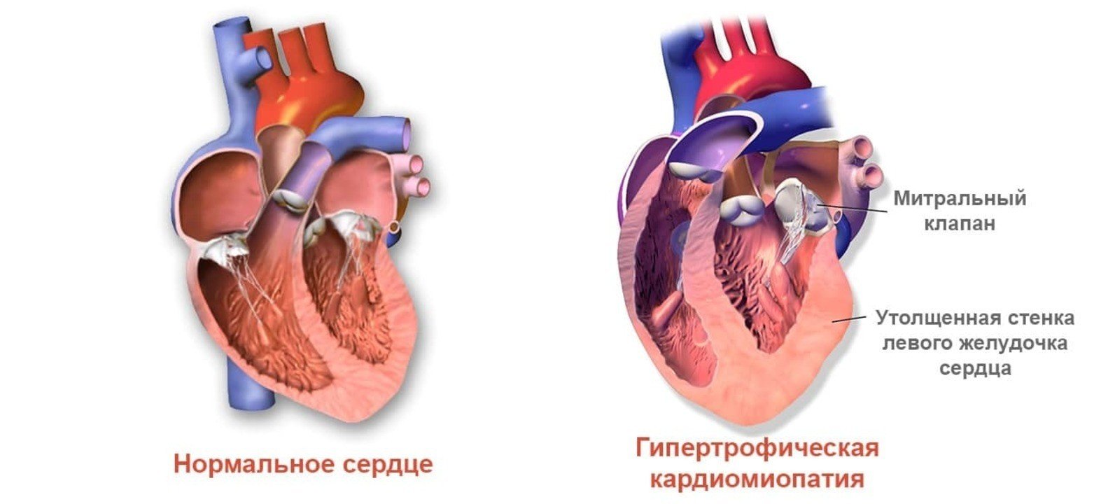 Миокард правого желудочка сердца. Гипертрофия левого желудочка гипертония. Гипертоническая болезнь и гипертрофия левого желудочка. Гипертрофия левого желудочка при гипертонической болезни. Гипертрофия левой желудочки сердце.