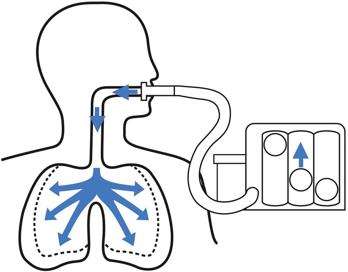 Тренажёр-спирометр дыхательный потоковый - Hudson RCI Triflo II. Дыхательный тренажер Spiro Ball. Прибор для дыхательных упражнений. Дыхательные тренажеры для детей. Используют дыхание зомби в качестве топлива