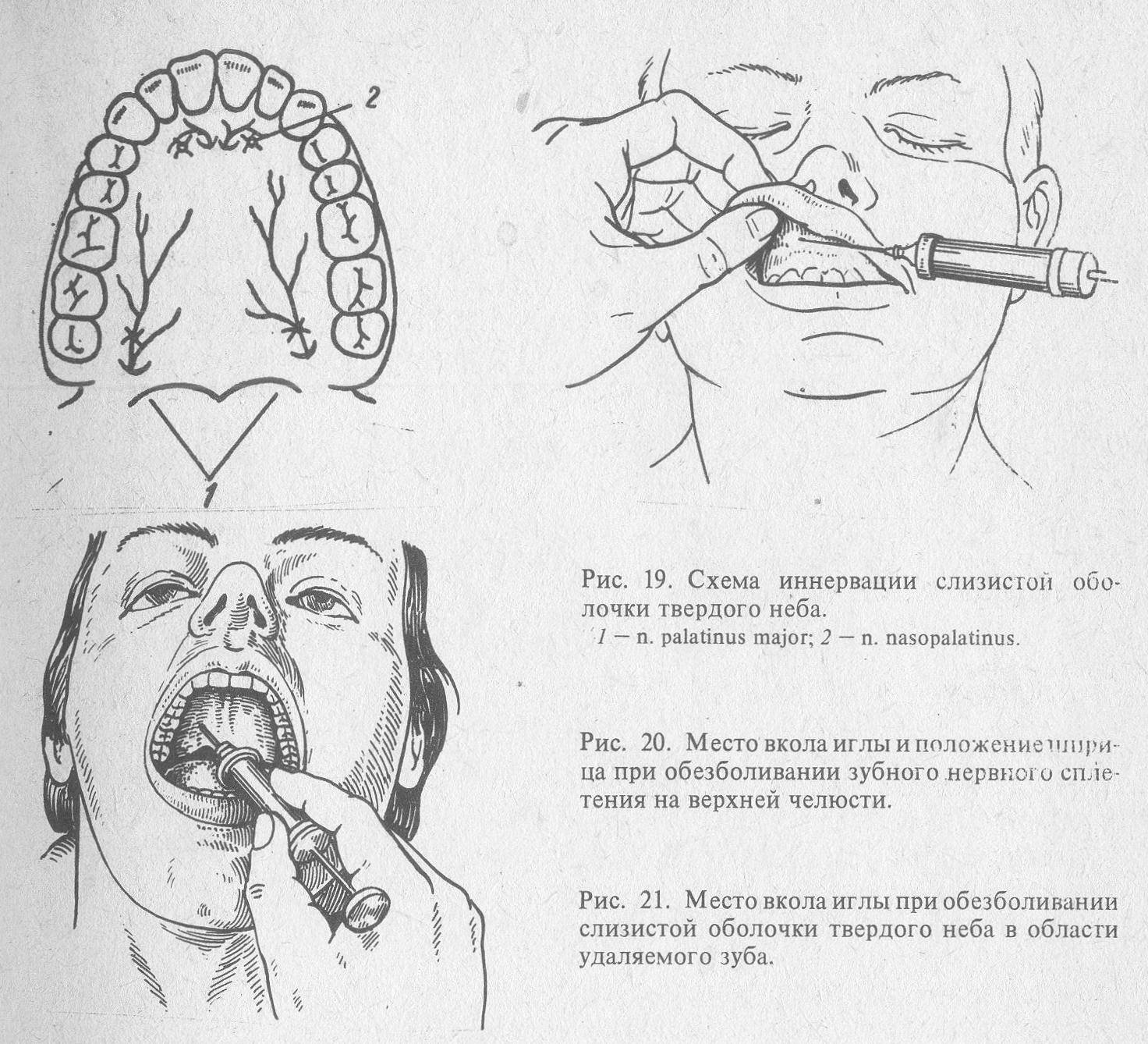 Анестезия полости рта