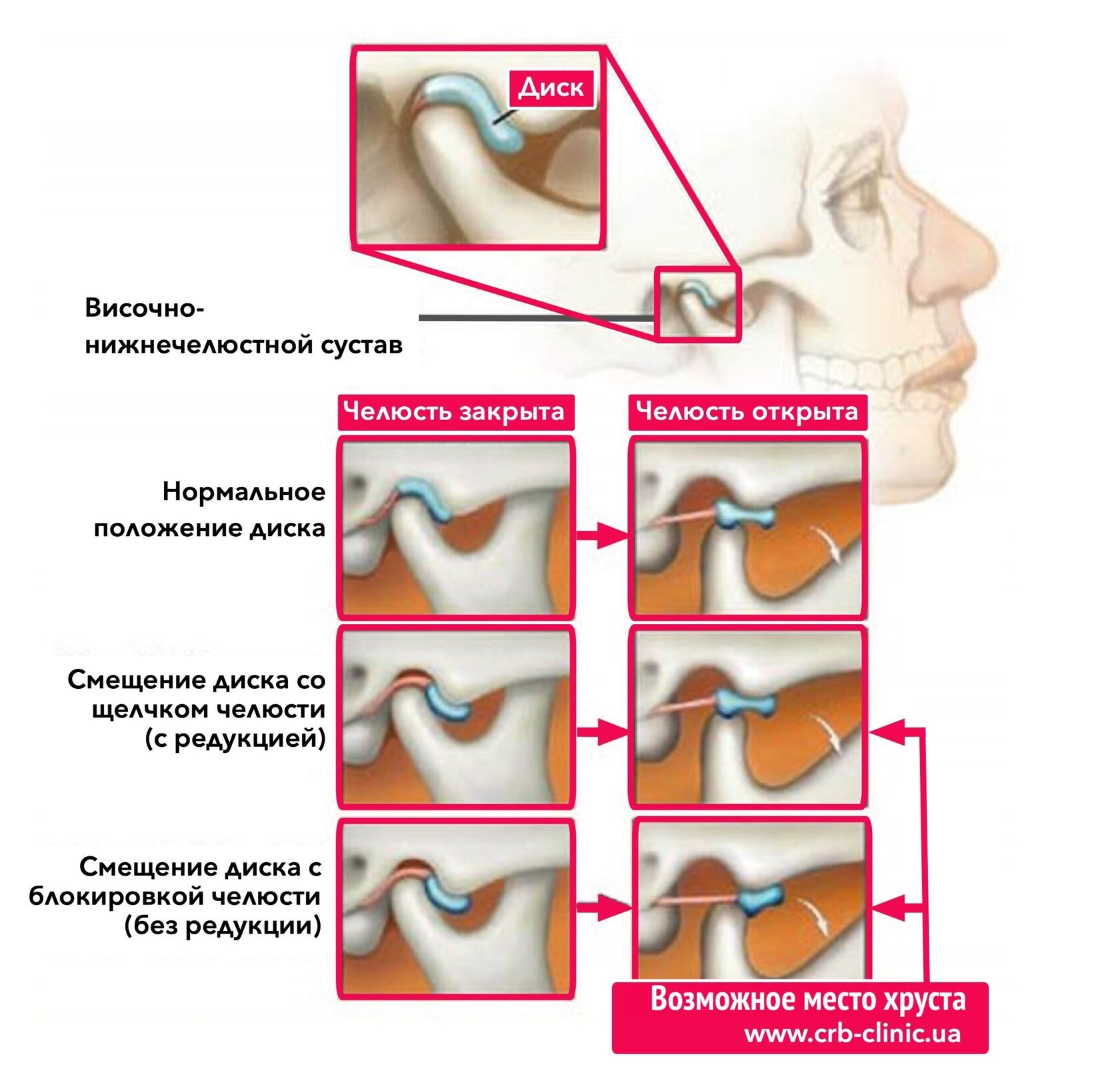 Болит челюсть при открытии возле уха. Переднее смещение суставного диска ВНЧС. Височно челюстной сустав.