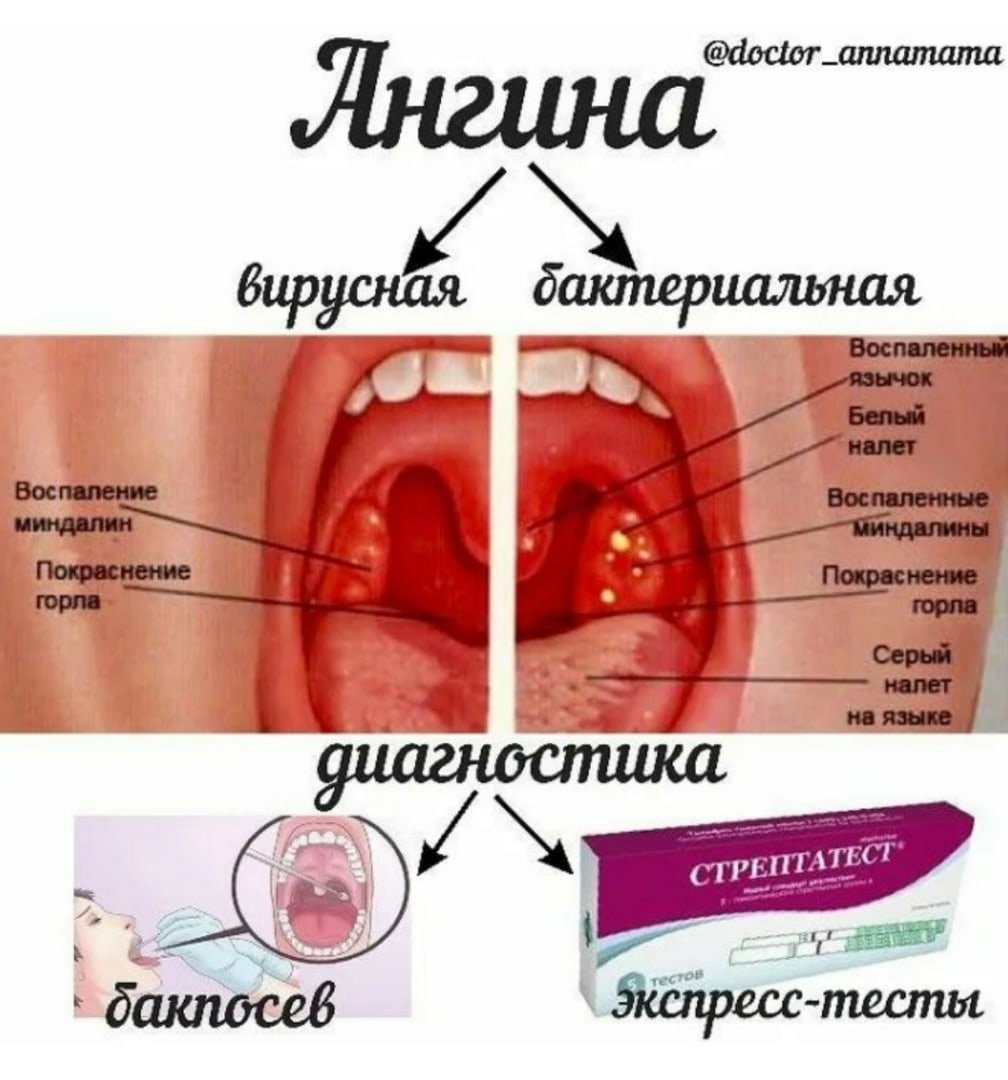 Во рту температура без. Бактериальная фолликулярная ангина. Герпесная ангина и бактериальная. Язвенно-плёнчатая форма тонзиллита.