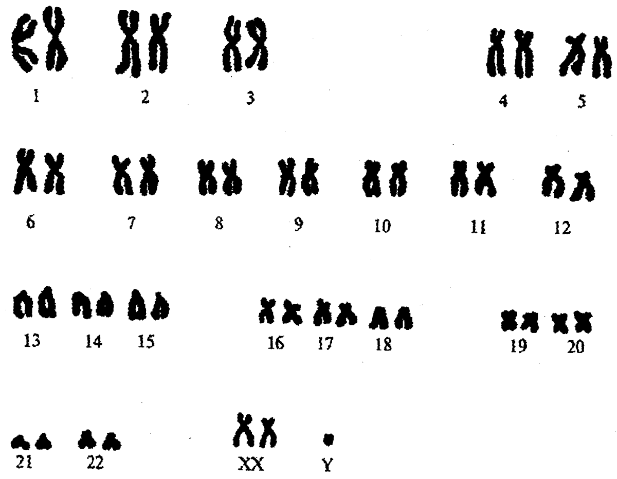 Синдром Клайнфельтера кариотип. Хромосомная карта синдрома Клайнфельтера. Синдром Клайнфельтера кариограмма. Кариотип синдрома Клайнфельда.