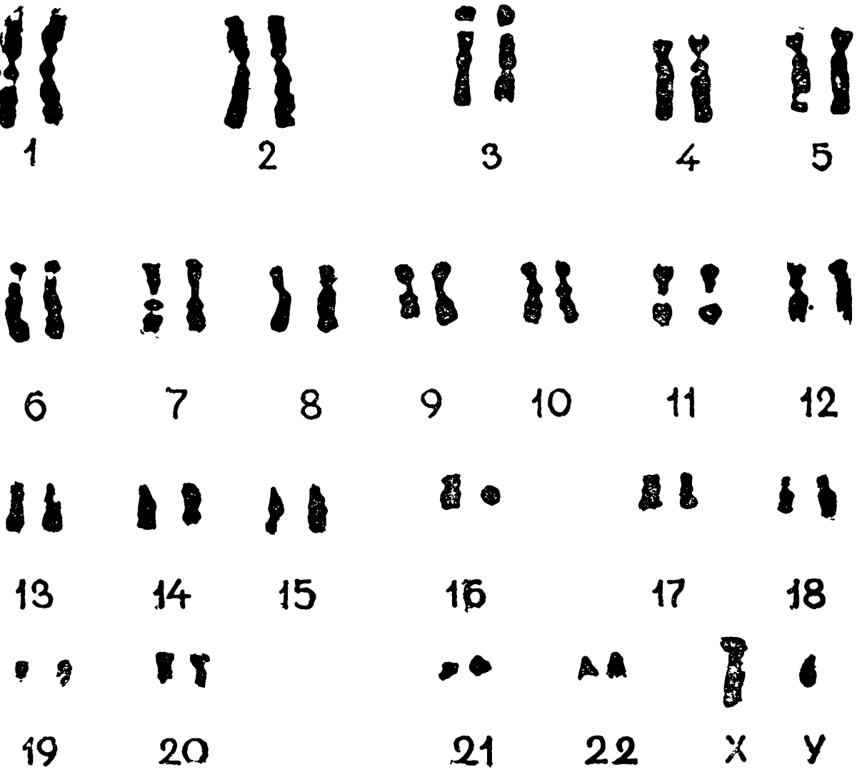23 хромосомы у человека в клетках. Нормальный кариотип человека 46 хромосом. Кариограмма хромосом здорового человека. Хромосомный набор кариотип человека. Хромосомная карта кариотип.