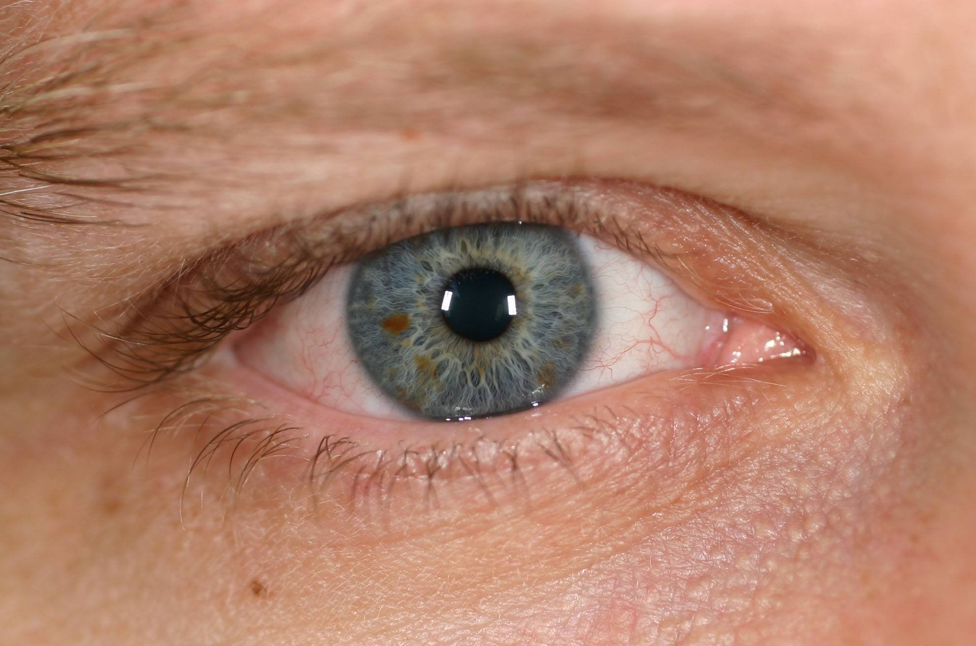 Почему глаза желтоватого. Эписклерит конъюнктивит. Пожелтение белков глаз.
