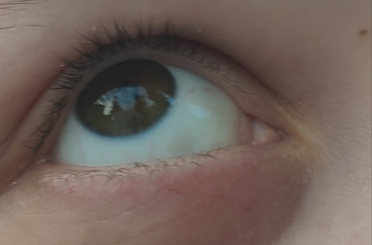 Темное пятно на глазном яблоке