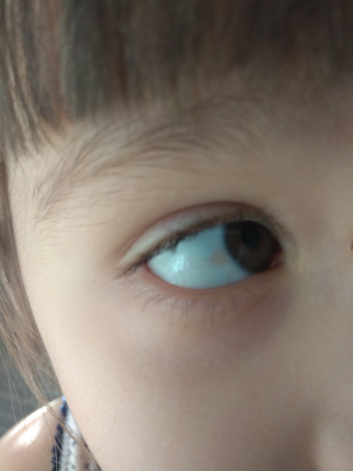 Невус конъюнктивы склеры