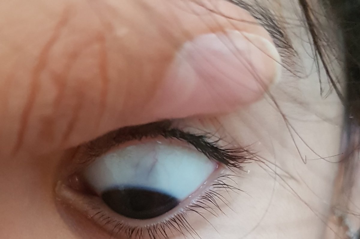 Красные сосуды на белках глаз