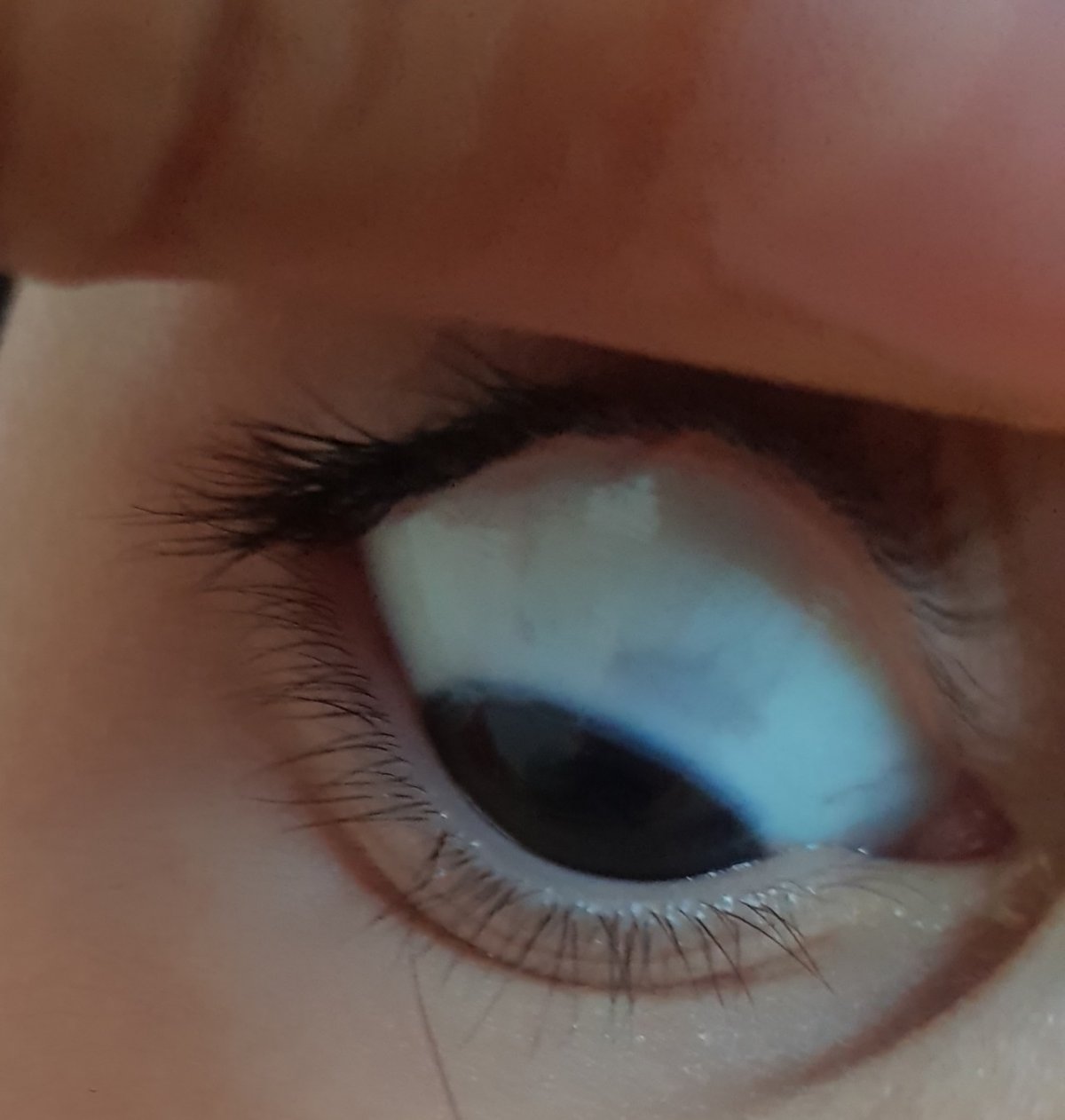 Прозрачный прыщик в глазу у ребенка