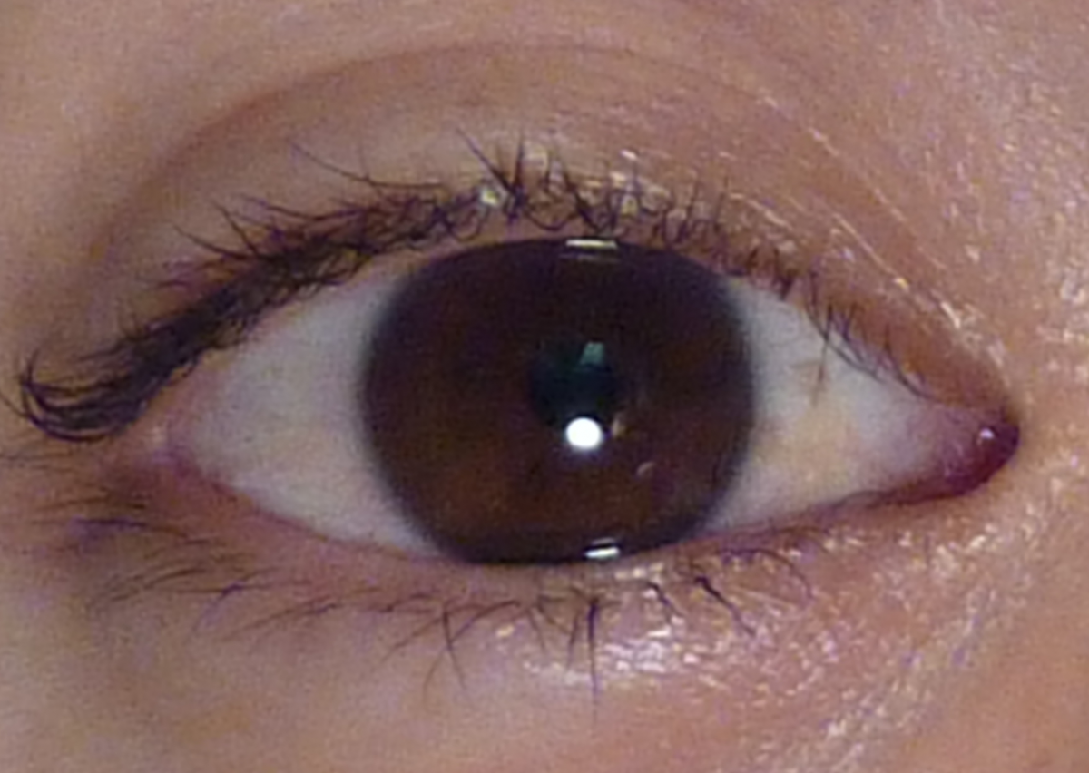 Веснушка на белке глаза