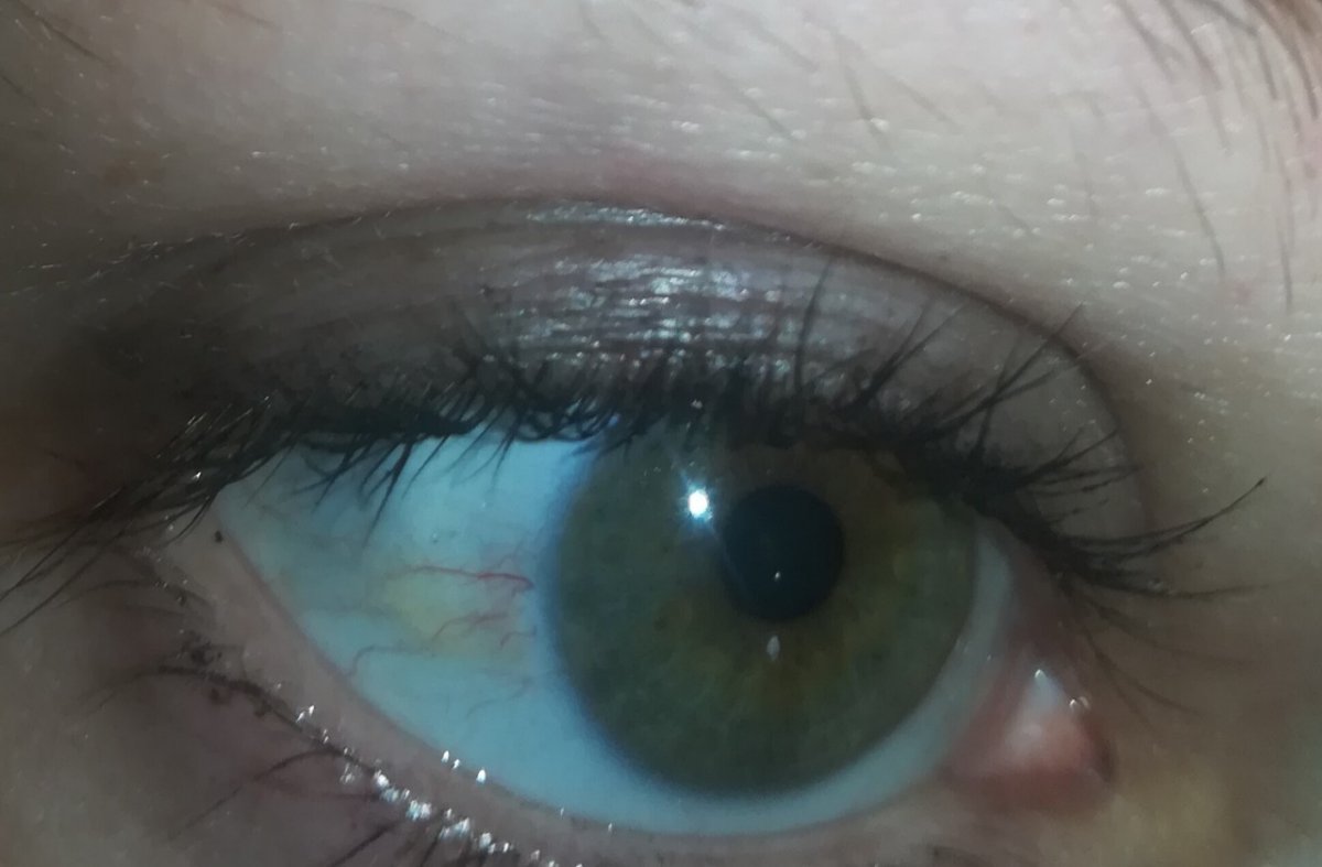 Серое пятнышко на белке глаза