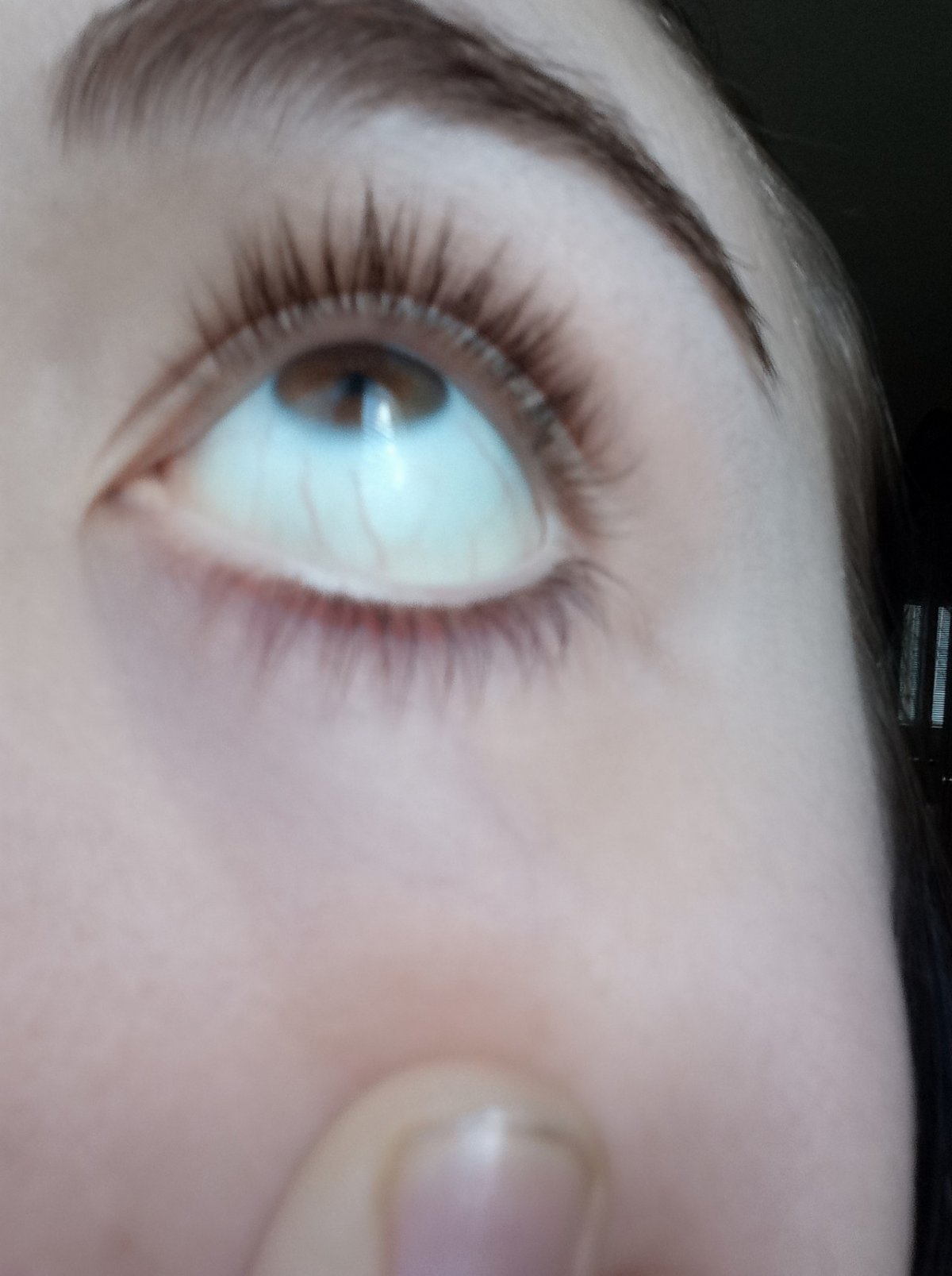 Иктеричность конъюнктивы