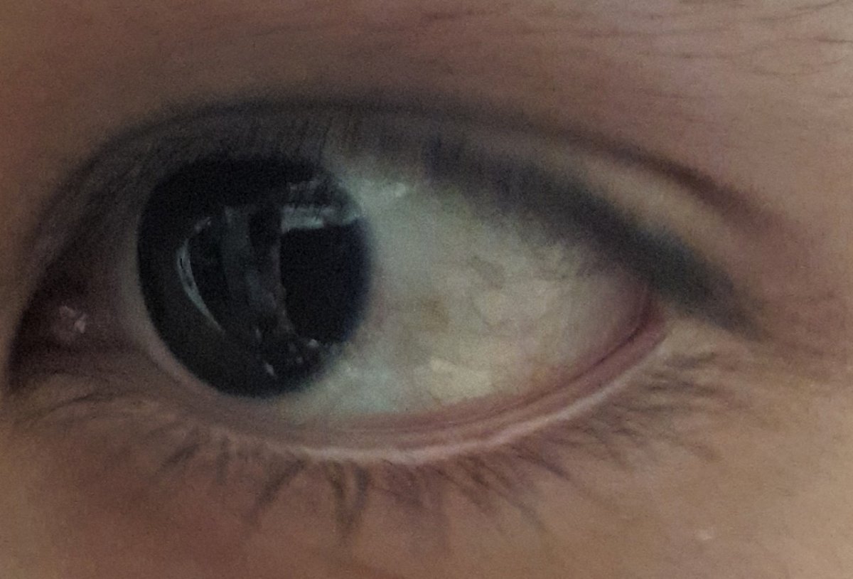 Темное пятнышко на белке глаза