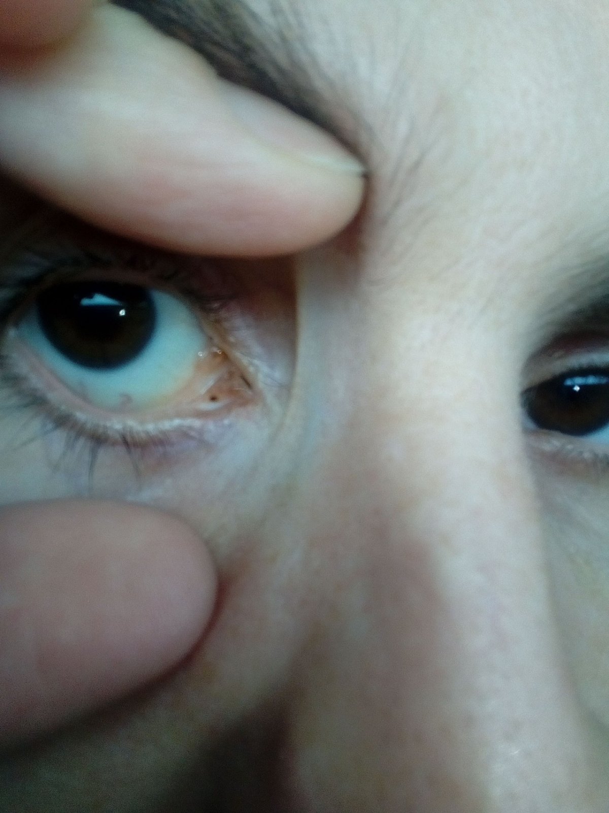 Коричневое пятнышко на белке глаза