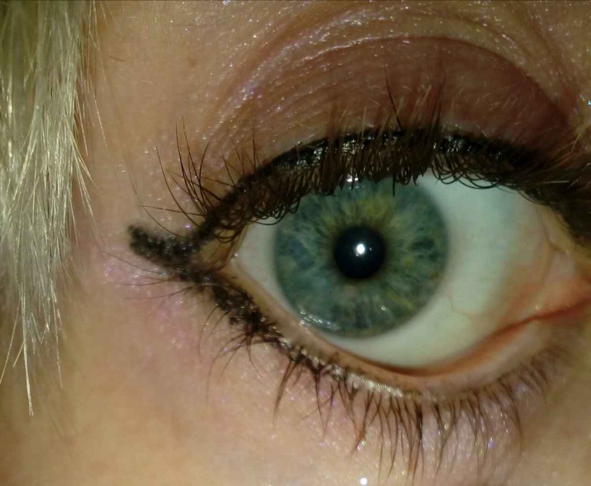 Капилляры на белках глаз