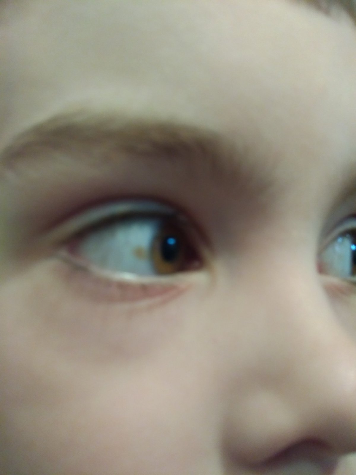 Белое пятнышко на глазу у ребенка