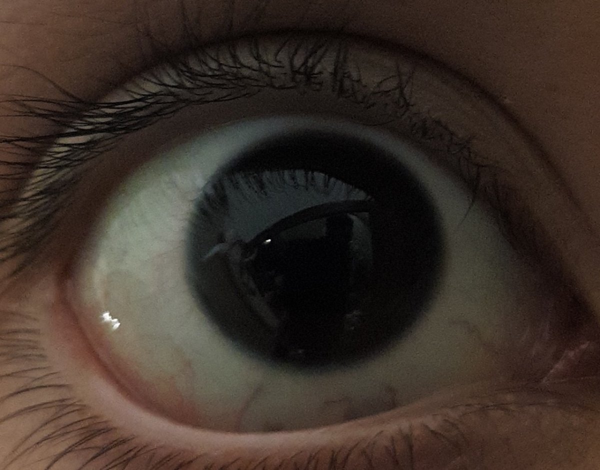 Белки глаз с красными прожилками