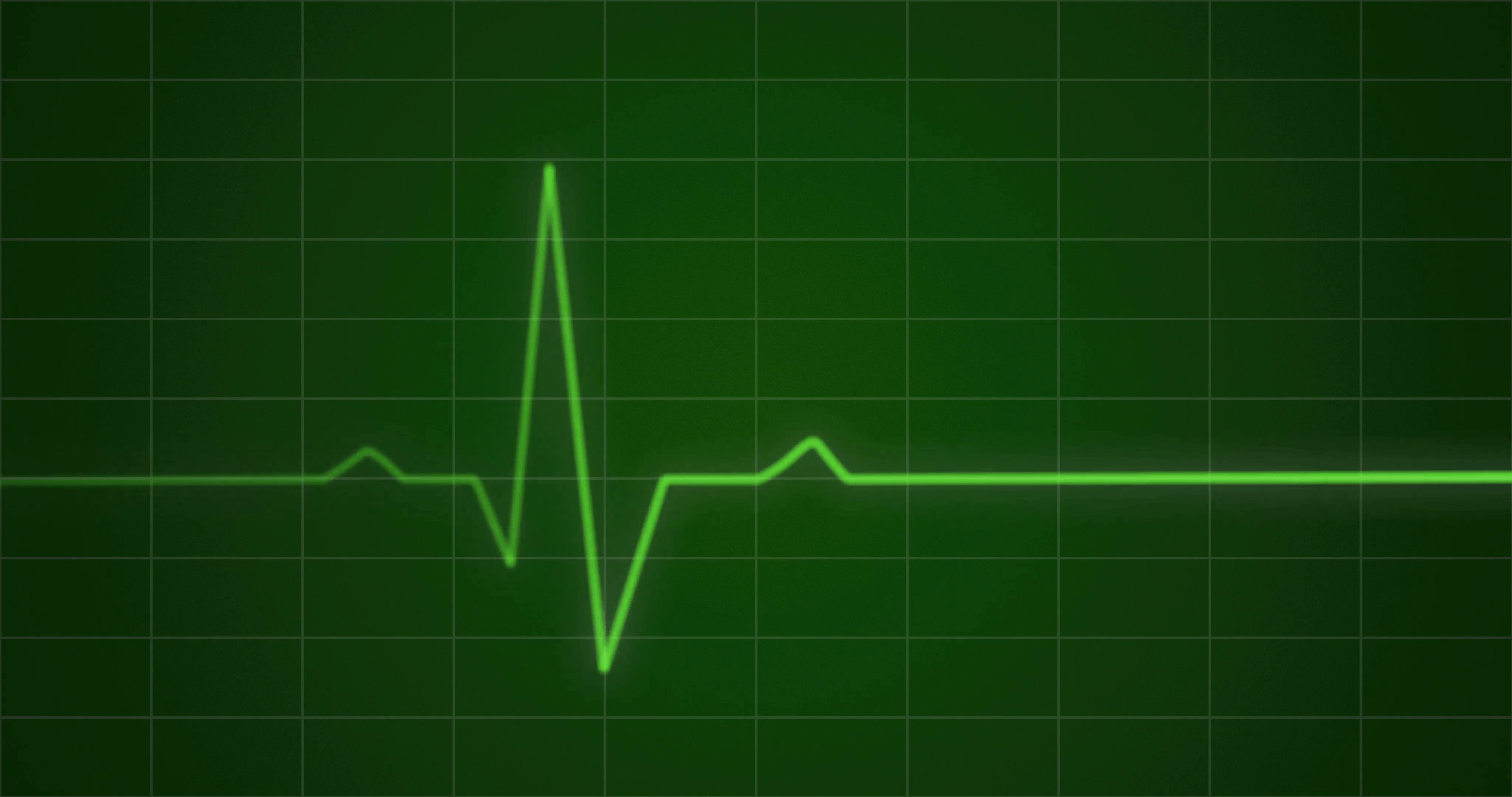Сердцебиение остановилось. Экран ЭКГ. Диаграмма пульса. Пульс на мониторе. Кардиограмма сердца.