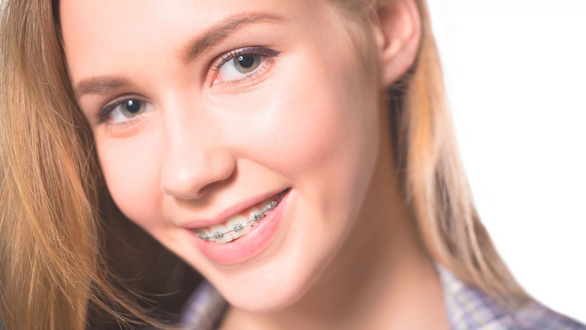 Анна МАКНАЛТИ брекеты