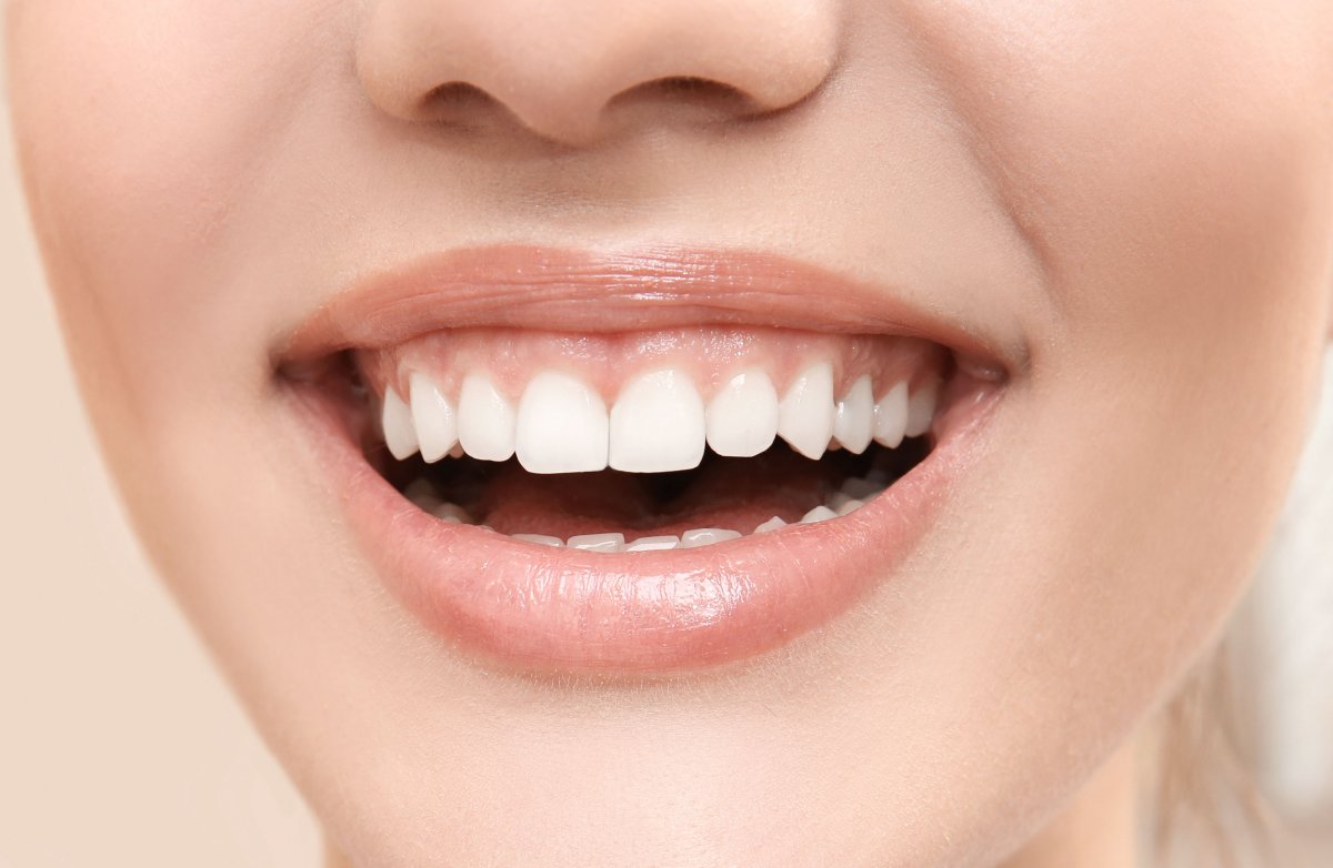 Белоснежная улыбка виниры