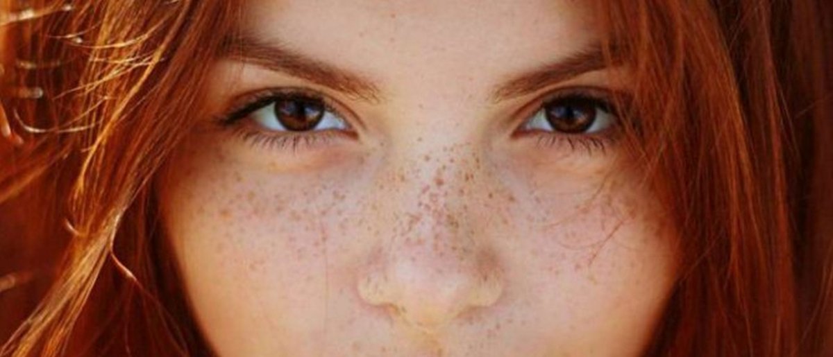 Девушка с проблемной кожей