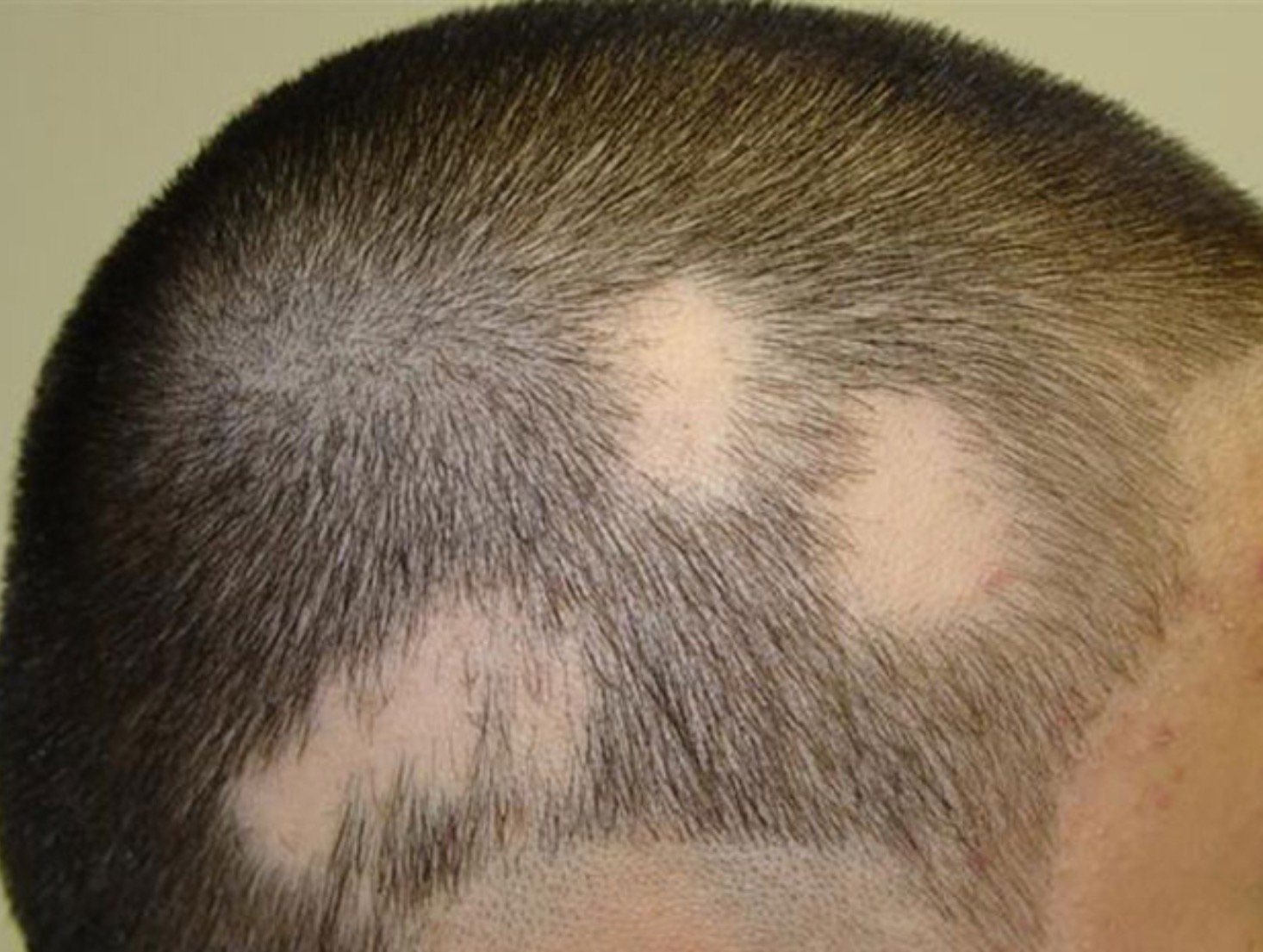 Очаговая алопеция (alopecia Areata)
