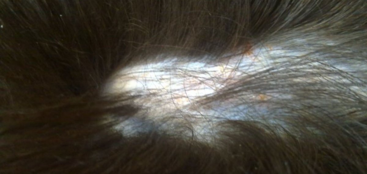 Выпадают волосы в паху у мужчин