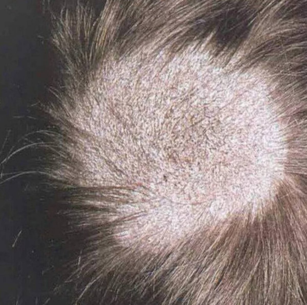 Гнездная алопеция офиазис