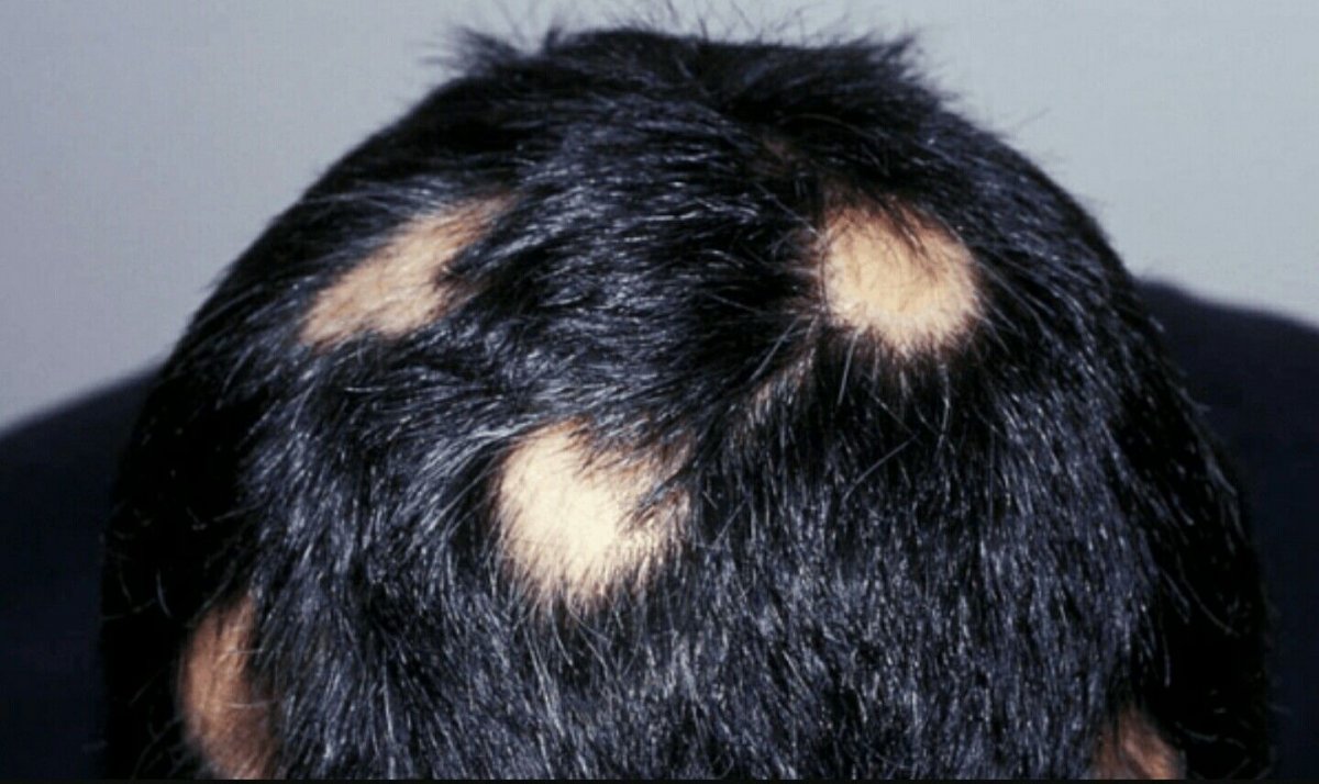 Очаговая (гнездная) алопеция