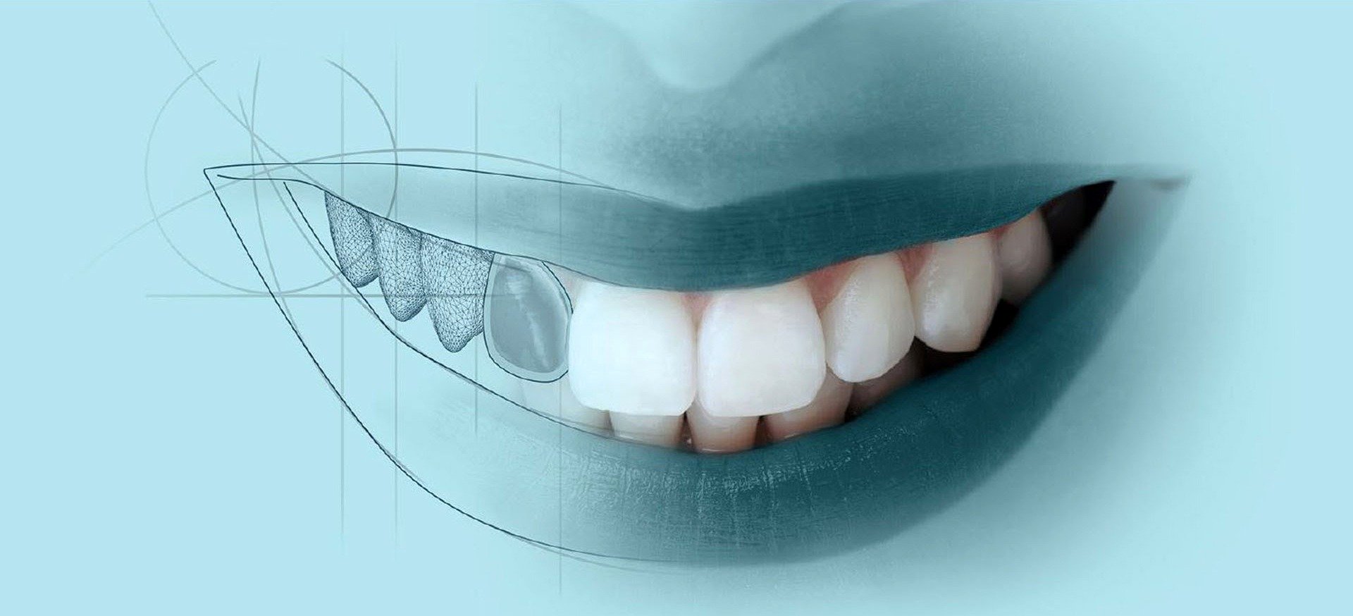 Винир ортопедическая стоматология 3д